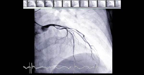 Cateterismo Cardíaco Arteria Descendente Anterior Izquierda Puede Ayudar Médico Diagnosticar —  Fotos de Stock
