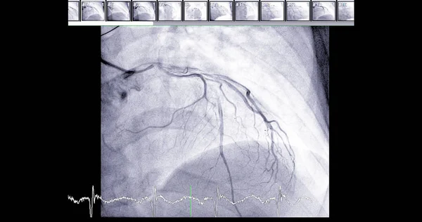 左前降动脉 Lad 的心脏导管可帮助医生诊断和治疗心脏和血管问题 如心脏病或中风 — 图库照片