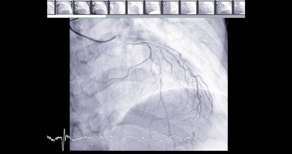 Cateterismo Cardíaco Artéria Descendente Anterior Esquerda Pode Ajudar Médico Diagnosticar — Fotografia de Stock