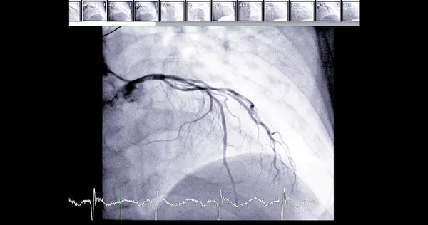 Cardiac catheterization on  left anterior descending artery (LAD) can help doctor diagnose and treat problems in your heart and blood vessels  such as a heart attack or stroke.