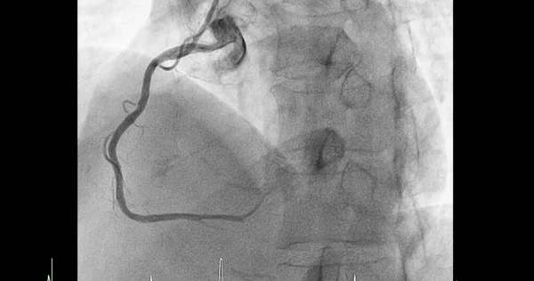 Cardiac catheterization on right coronary artery (RCA) can help doctor diagnose and treat problems in your heart and blood vessels  such as a heart attack or stroke.