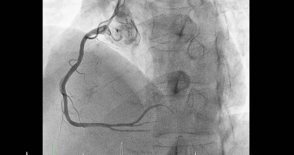 Cateterismo Cardíaco Artéria Coronária Direita Acd Pode Ajudar Médico Diagnosticar — Fotografia de Stock