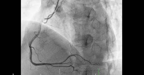 Cateterismo Cardíaco Artéria Coronária Direita Acd Pode Ajudar Médico Diagnosticar — Fotografia de Stock