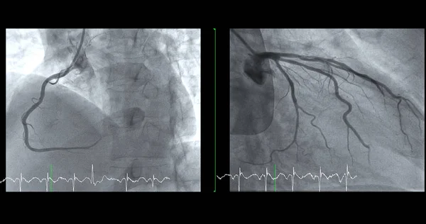 Cateterismo Cardíaco Acr Puede Ayudar Médico Diagnosticar Tratar Problemas Corazón —  Fotos de Stock