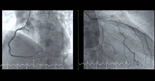 Cateterismo Cardíaco Rca Lad Pode Ajudar Médico Diagnosticar Tratar Problemas — Fotografia de Stock