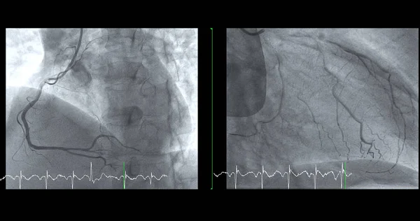 Cateterismo Cardíaco Acr Puede Ayudar Médico Diagnosticar Tratar Problemas Corazón —  Fotos de Stock