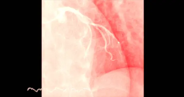 Cateterizzazione Cardiaca Sull Arteria Discendente Anteriore Sinistra Lad Può Aiutare — Foto Stock