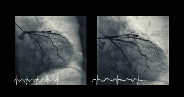 Cateterismo Cardíaco Pode Ajudar Médico Diagnosticar Tratar Problemas Coração Nos — Fotografia de Stock