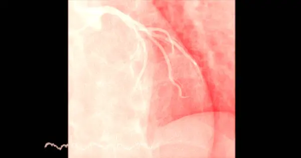 Καρδιακός Καθετηριασμός Στην Αριστερή Πρόσθια Κατιούσα Αρτηρία Lad Μπορεί Βοηθήσει — Φωτογραφία Αρχείου