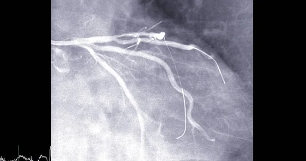 Cateterismo Cardíaco Arteria Descendente Anterior Izquierda Puede Ayudar Médico Diagnosticar —  Fotos de Stock
