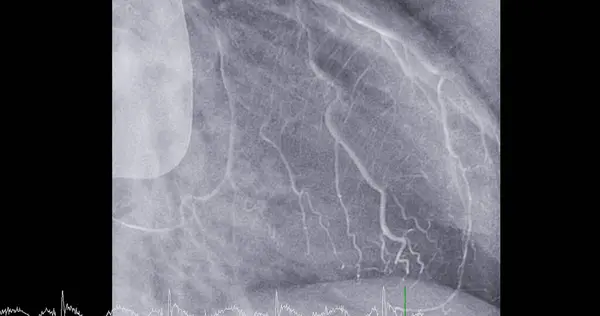 Cateterismo Cardíaco Arteria Descendente Anterior Izquierda Puede Ayudar Médico Diagnosticar — Foto de Stock