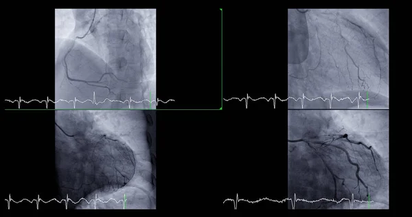 Cateterismo Cardíaco Puede Ayudar Médico Diagnosticar Tratar Problemas Corazón Los — Foto de Stock
