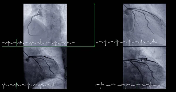 Cateterismo Cardíaco Puede Ayudar Médico Diagnosticar Tratar Problemas Corazón Los — Foto de Stock
