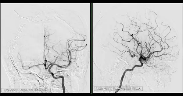 Зображення Церебральної Ангіографії Від Флюороскопії Інтервенційній Радіології Показує Мозкову Артерію — стокове фото
