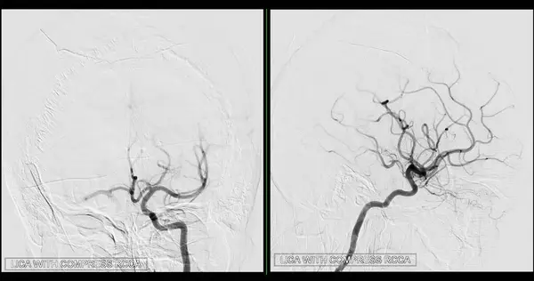 Зображення Церебральної Ангіографії Від Флюороскопії Інтервенційній Радіології Показує Мозкову Артерію — стокове фото