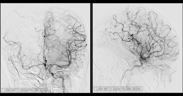 Cerebral Angiography Image Fluoroscopy Intervention Radiology Showing Cerebral Artery — Foto de Stock