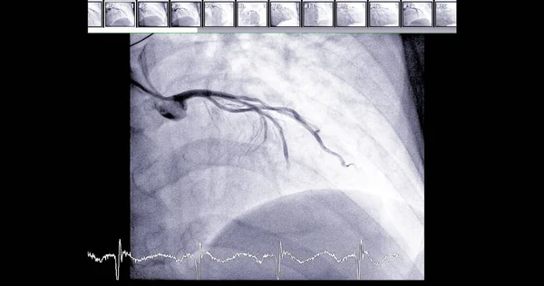 心脏导管化可以帮助医生诊断和治疗心脏和血管中的问题 否则这些问题可能会导致更大的问题 如心脏病发作或中风 — 图库照片