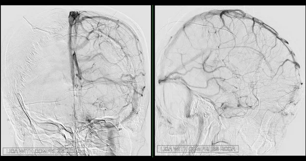 Cerebral Angiography Image Fluoroscopy Intervention Radiology Showing Cerebral Artery — Fotografia de Stock