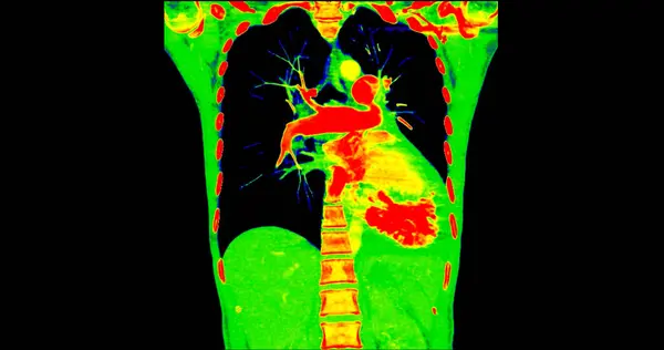 診断パルモナリエンボリズム 肺がんおよびコビド 19のための色モードの胸角ビューのCtスキャン — ストック写真