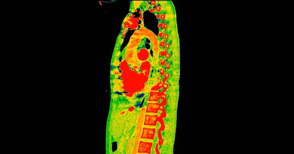 診断パルモナリエンボリズム 肺がんおよびコビド 19のための色モードの胸のシタールビューのCtスキャン — ストック写真