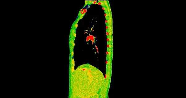 診断パルモナリエンボリズム 肺がんおよびコビド 19のための色モードの胸のシタールビューのCtスキャン — ストック写真