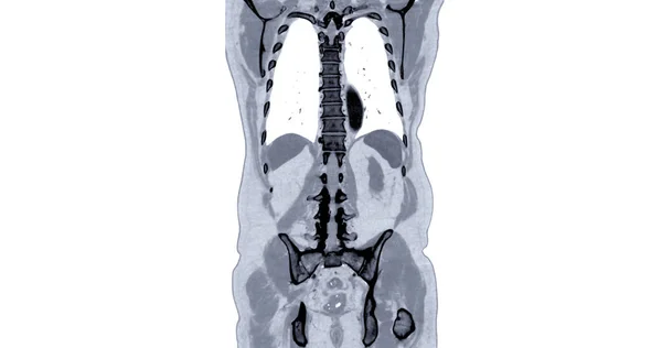 Tórax Abdome Com Contraste Injeção Visão Coronal Para Diagnóstico Dor — Fotografia de Stock