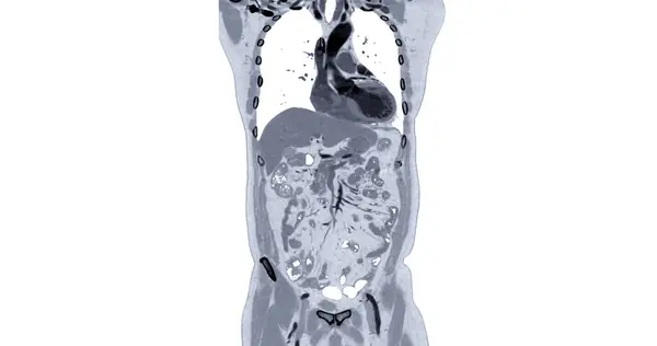 Klatki Piersiowej Brzucha Wtryskiem Kontrast Medialny Widok Koronowany Diagnozy Bólu — Zdjęcie stockowe