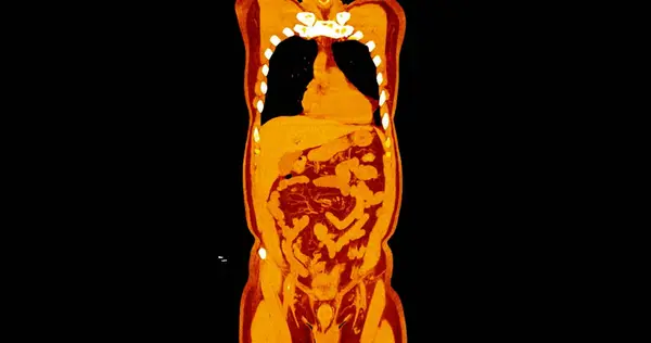 Klatki Piersiowej Brzucha Wtryskiem Kontrast Medialny Widok Koronowany Diagnozy Bólu — Zdjęcie stockowe