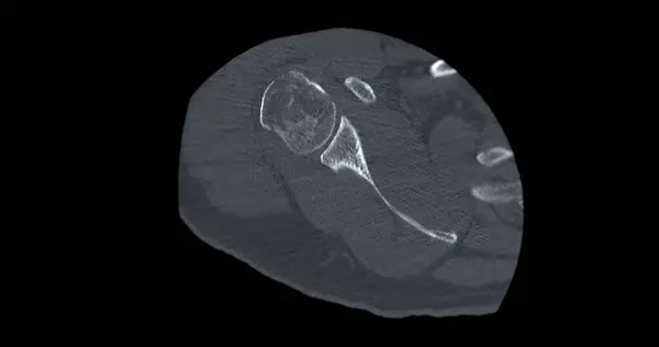 Сканування Плечового Суглоба Переломі Плечового Суглоба — стокове фото