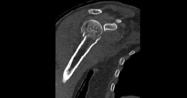 Scan Shoulder Joint Case Fracture Shoulder Joint — Stock Photo, Image