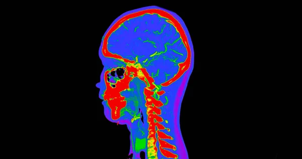 Ct脑血管造影或Cta脑颈部矢状扫描观察3D渲染图像融合颜色模式 医疗技术概念 — 图库照片
