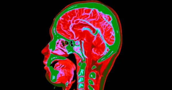 stock image CT angiography of the brain or CTA brain and neck Sagittal view 3D Rendering image fusion color mode . medical technology concept.