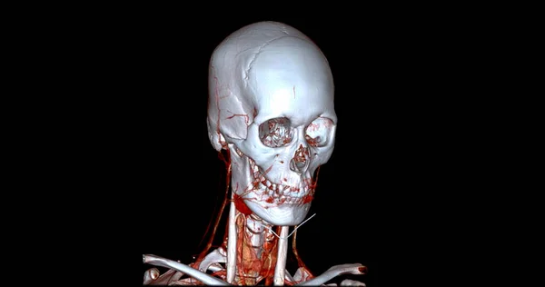 Angiography Brain Cta Brain Neck Sagittal View Rendering Image Fusion — Stock Photo, Image