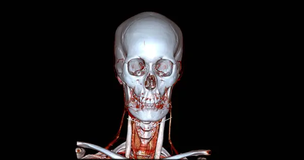 脳またはCta脳と首の射手ビュー3Dレンダリング画像融合カラーモードのCt角膜 医療技術コンセプト — ストック写真