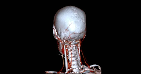 Cta 혈관조영술 Sagittal View 렌더링 이미지 — 스톡 사진