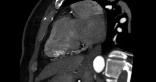 Cta Artera Coronariană Vizualizare Verticală Axei Lungi Pentru Diagnosticarea Stenozei — Fotografie, imagine de stoc