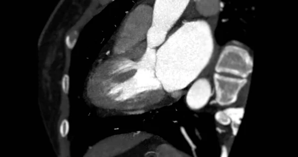 Cta Coronaria Vertiva Hosszú Tengely Nézet Diagnosztizálására Koszorúér Szűkület — Stock Fotó