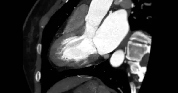 Cta Koronare Arterienvertikale Langachsdarstellung Zur Diagnose Der Gefäßkoronararterienstenose — Stockfoto