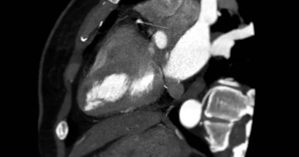 Cta Koronar Arterie Vertikal Lang Akse Visning Diagnostisering Kar Koronar – stockfoto