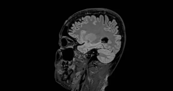Ressonância Magnética Flair Sagital Cérebro Para Detectar Doenças Cerebrais Sush — Fotografia de Stock
