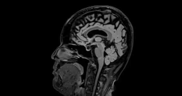 Resonancia Magnética Escaneo Cerebral Estilo Sagital Para Detectar Enfermedades Cerebrales — Foto de Stock