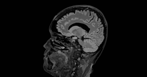 Мрт Мозга Сканировать Сагиттальное Чутье Обнаружения Суши Болезни Мозга Инсульта — стоковое фото