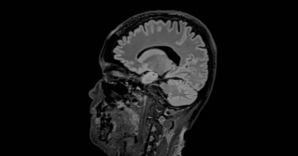 Mri Brain Scan Sagittal Flair Detect Brain Diseases Sush Stroke — Stock Photo, Image
