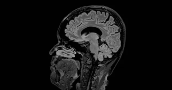 Mri Agyi Vizsgálat Sagittal Hangulat Kimutatására Brain Betegségek Sush Stroke — Stock Fotó