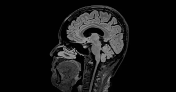 MRI  brain scan  sagittal flair for detect  Brain  diseases sush as stroke disease, Brain tumors and Infections.