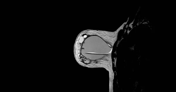 Brust Mrt Oder Magnetresonanztomographie Der Brust Beidseitig Mit Silikonimplantat Bei — Stockfoto