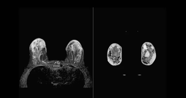 유방암 검진을 여성의 실리콘 임플란트와 유방암 양쪽의 Mri 자기공명영상 — 스톡 사진