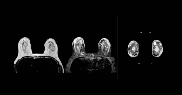 Göğüs Göğüs Röntgeninin Her Iki Tarafında Göğüs Silikonu Olan Göğüs — Stok fotoğraf