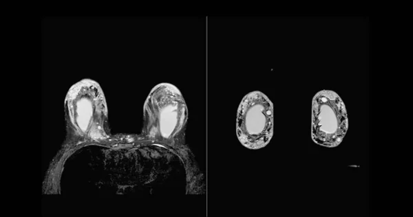 Bröst Mrt Eller Magnetisk Resonanstomografi Bröst Båda Sidor Med Bröst — Stockfoto