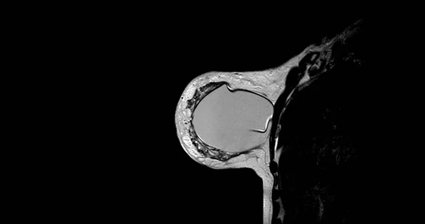 Mri Piersi Lub Rezonans Magnetyczny Piersi Obu Stronach Implantem Silikonu — Zdjęcie stockowe